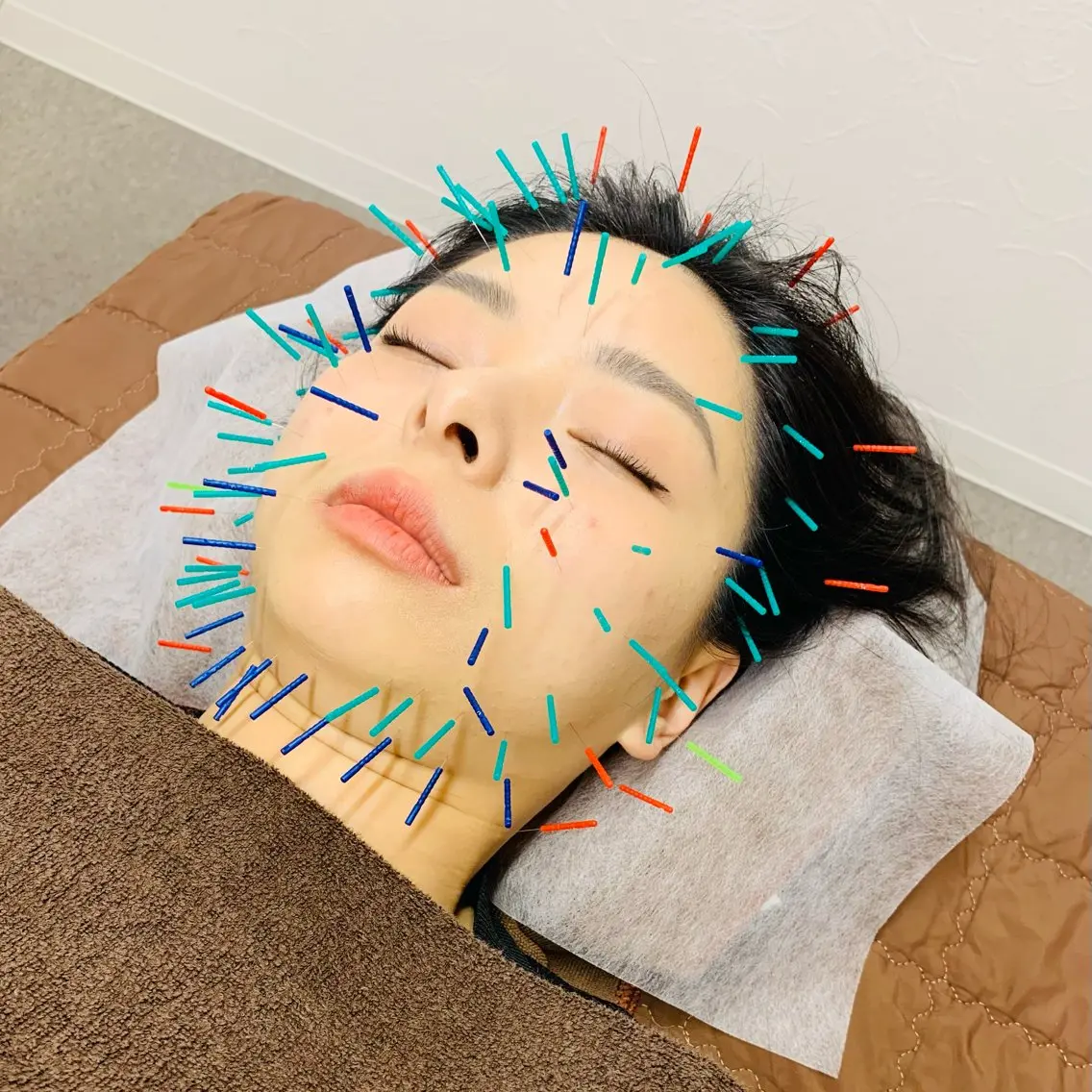 サボテン美容鍼(新メニューモニター)の写真