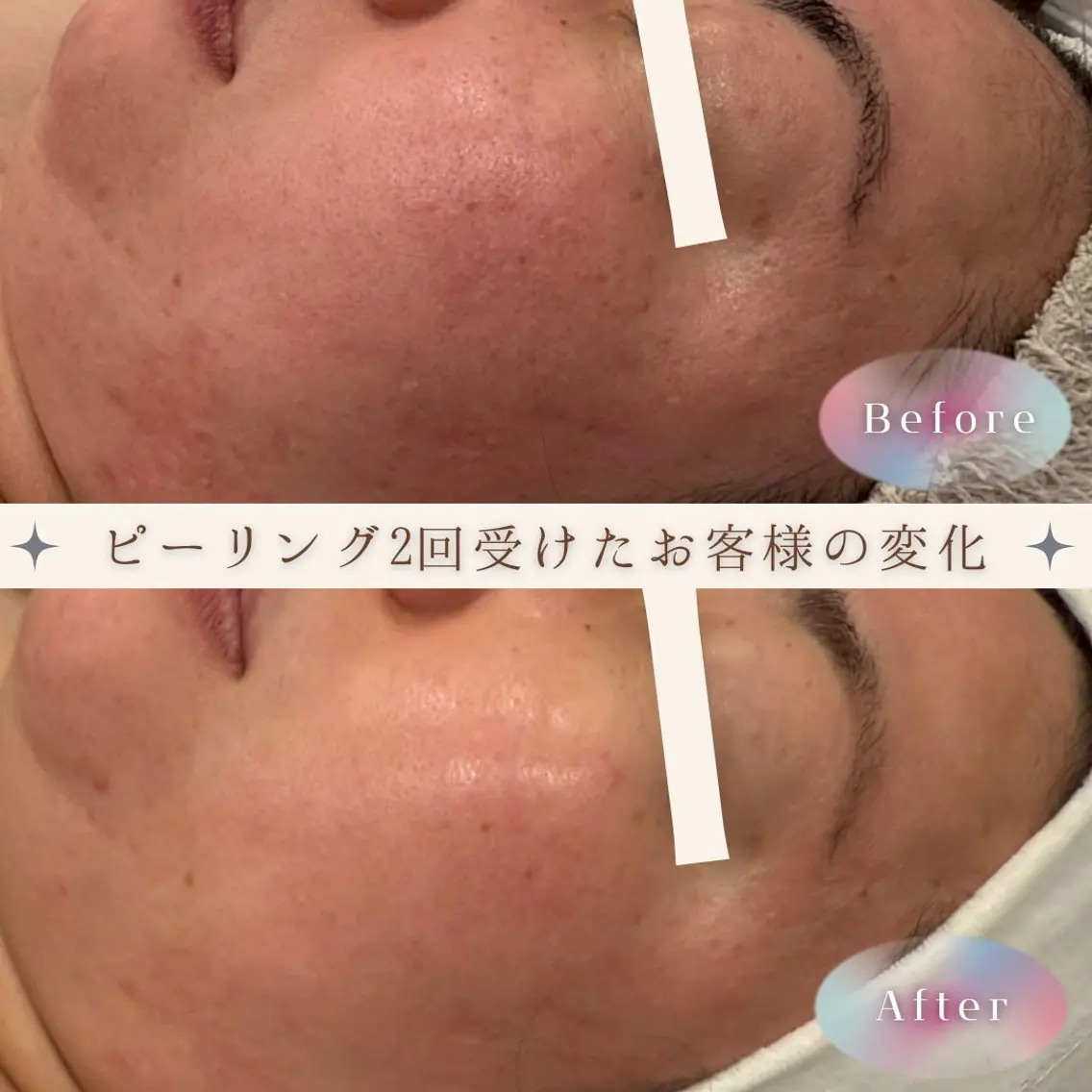 【初回鎮静ジェル付き!】肌質改善ハーブピーリング➕デコルテマッサージ🪸2回回数券‼️1回分が半額✨の写真