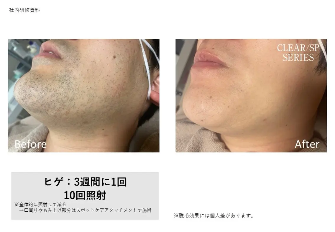 全顔脱毛パックの写真