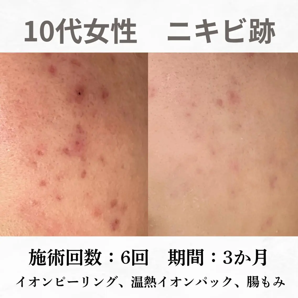 重度ニキビ専門🌷 ダウンタイムなしのエステ・リラクイメージ