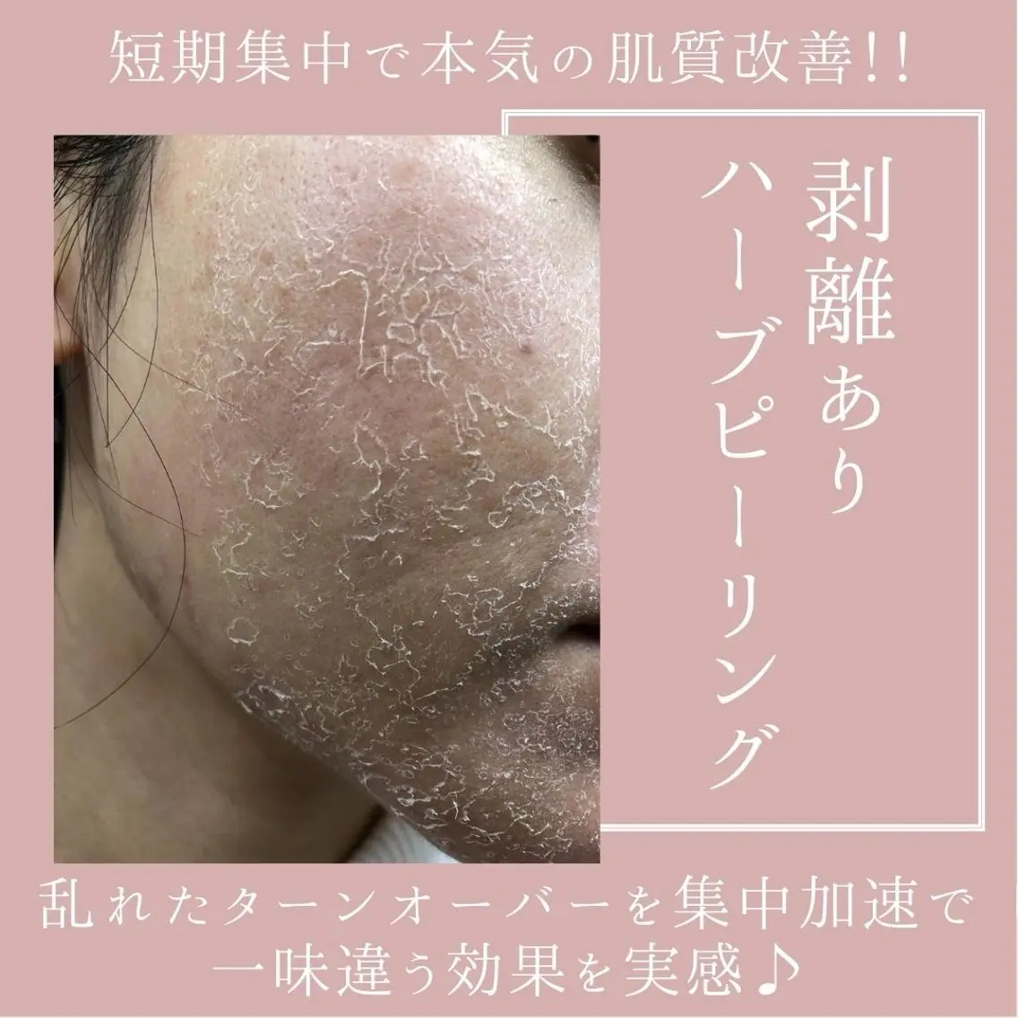 ♦️人気No.1♦️【剥離ありハーブピーリング•フェイス】ニキビ•ニキビ跡•毛穴◎すぐ実感!スペシャルハーブピーリングの写真