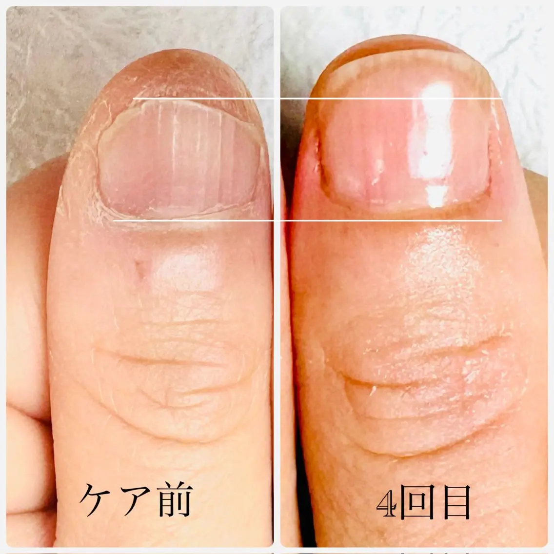 深爪集中ケアプログラム(ホームケア用品込み)の写真