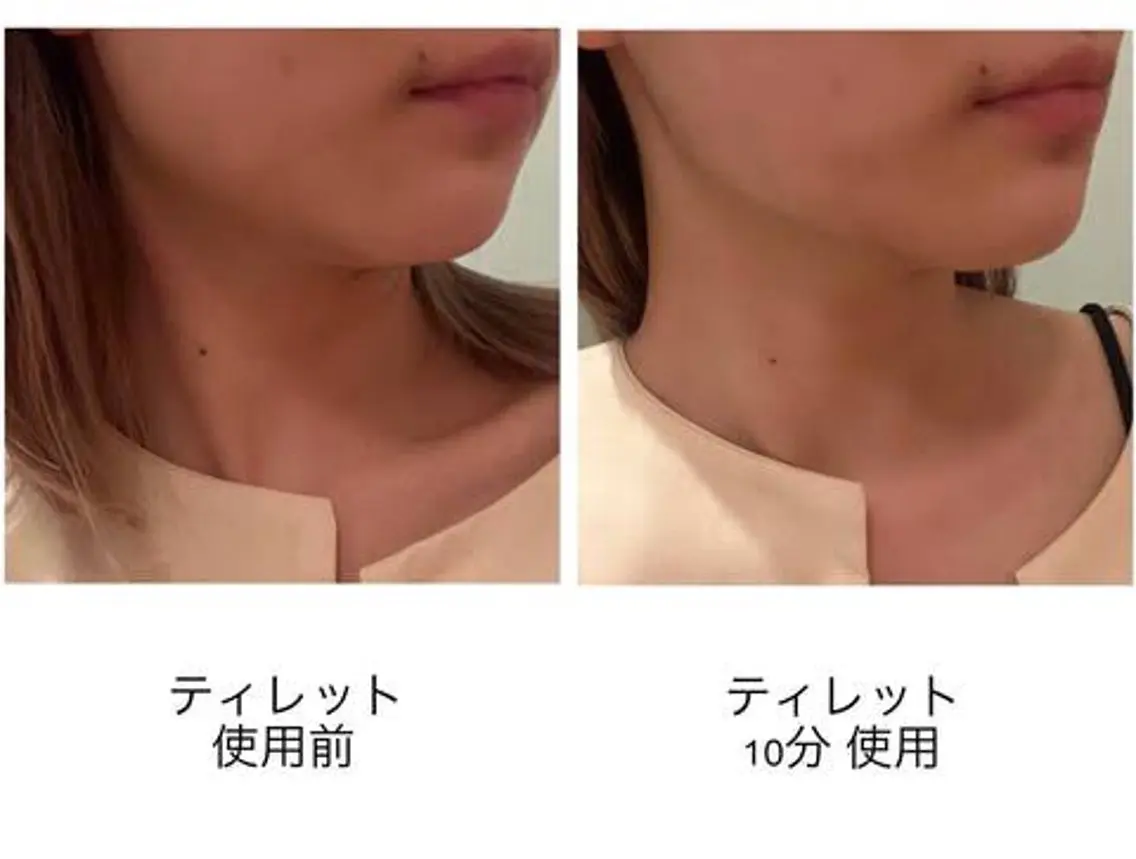 🔶美顔🔶ティレット体験70分!デンキバリブラシの後発機体験+毛穴洗浄+マッサージ+マスク¥6000の写真