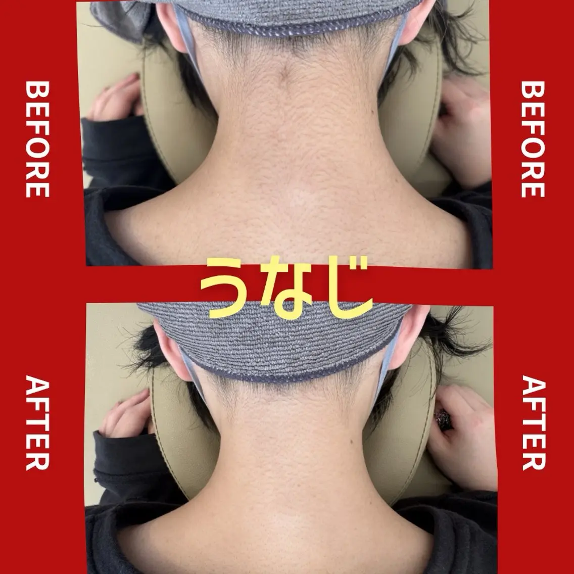 【女性人気】うなじ脱毛の写真