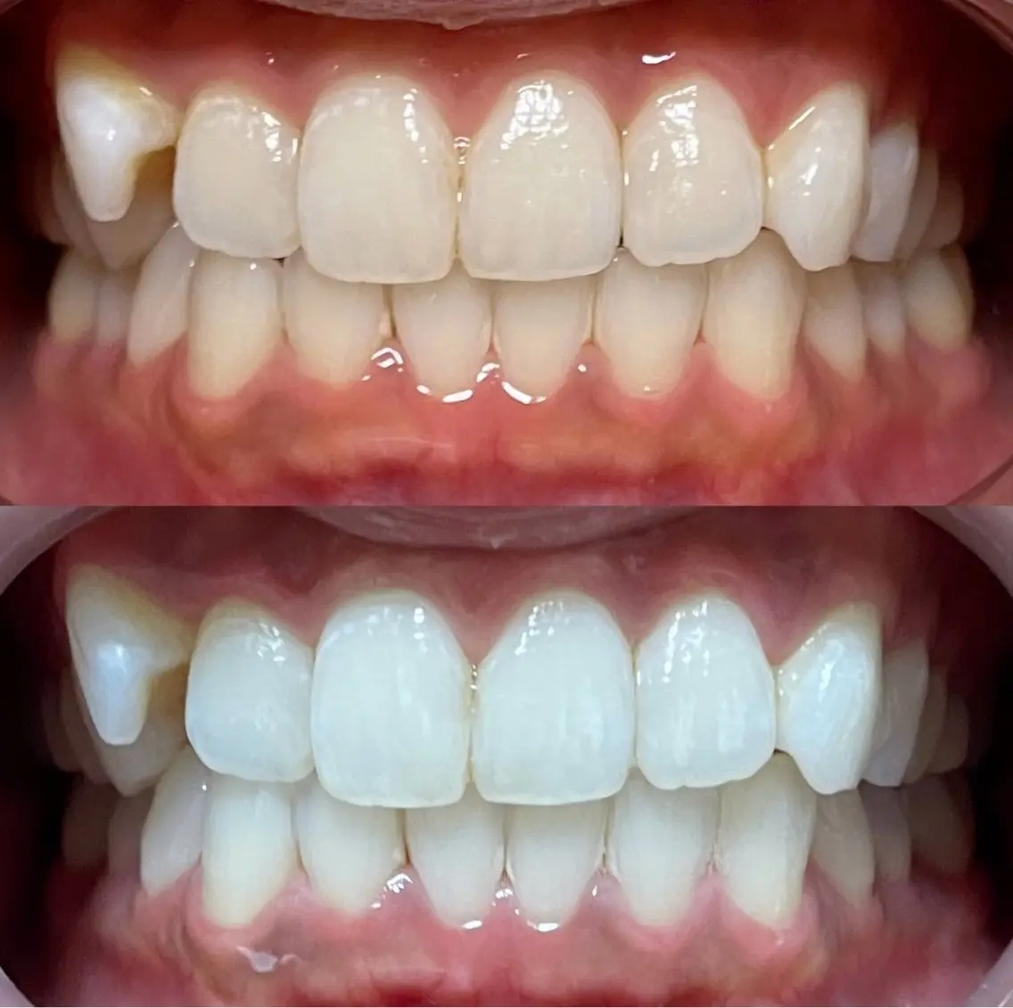 セルフホワイトニング🦷8分×2回照射(空きはリクエストからお問い合わせください)の写真
