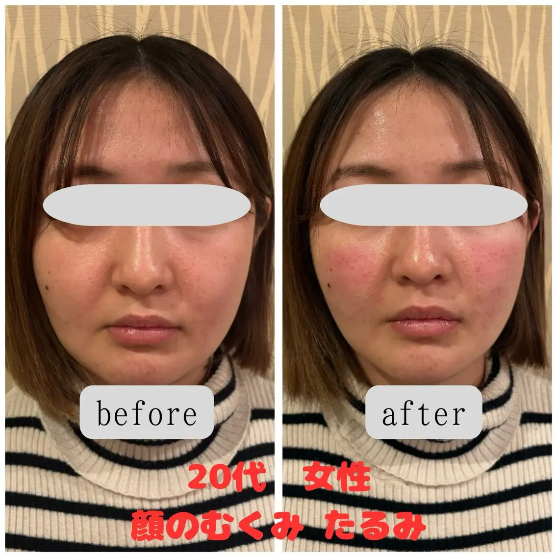 【人気No.2】2回目以降 プレミアム美容鍼の写真