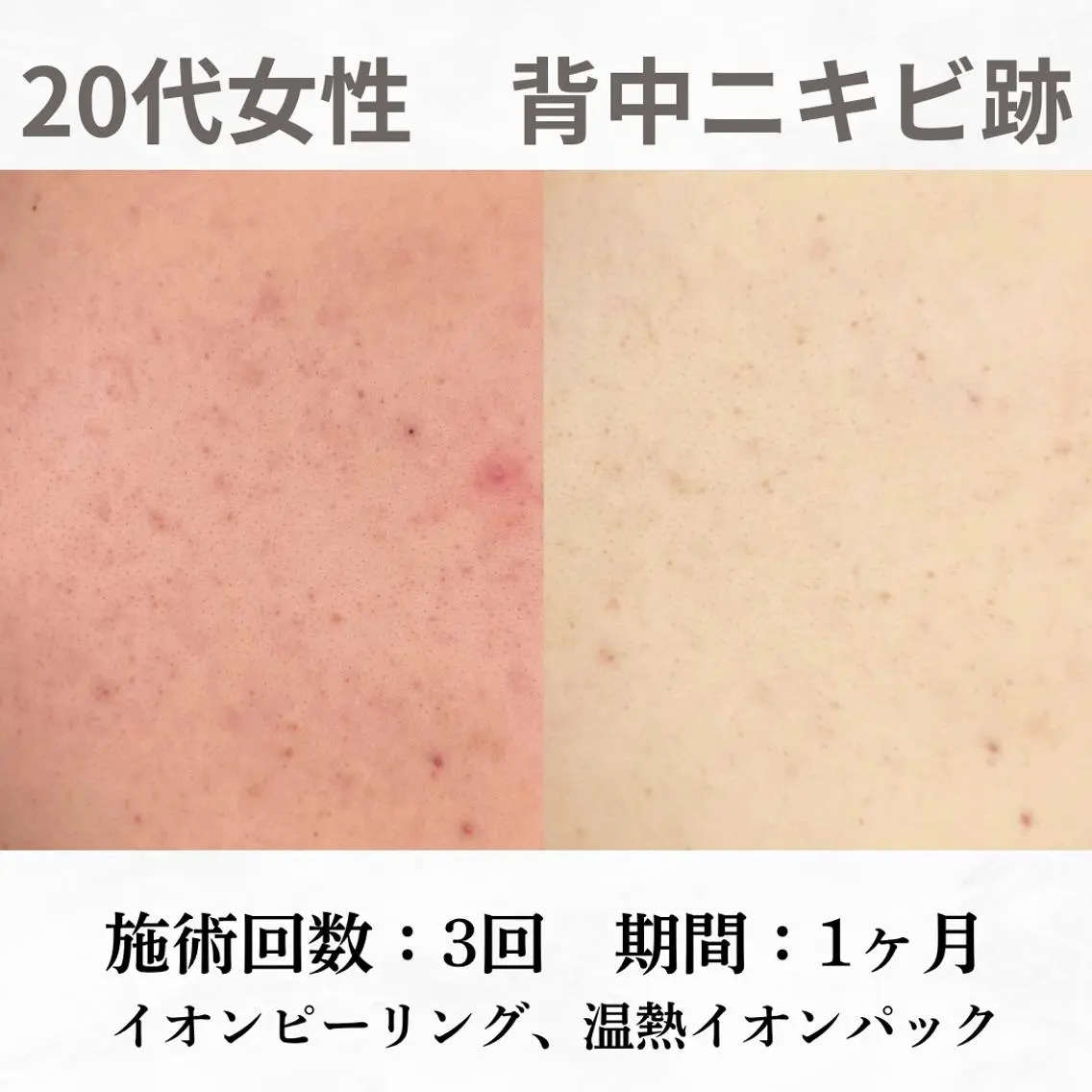 重度ニキビ専門🌷 ダウンタイムなしのエステ・リラクイメージ
