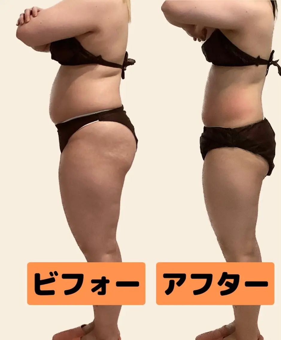 🌟痩身60分🌟後ろ姿美人❗️背中＋二の腕＋肩＋腰回り集中オーダーメイド60分（キャビ+ラジオ波+吸引/EMS)の写真