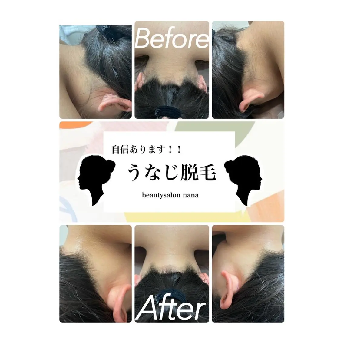【LADY's.KID's】うなじ脱毛☆めざせ!後ろ美人♪の写真