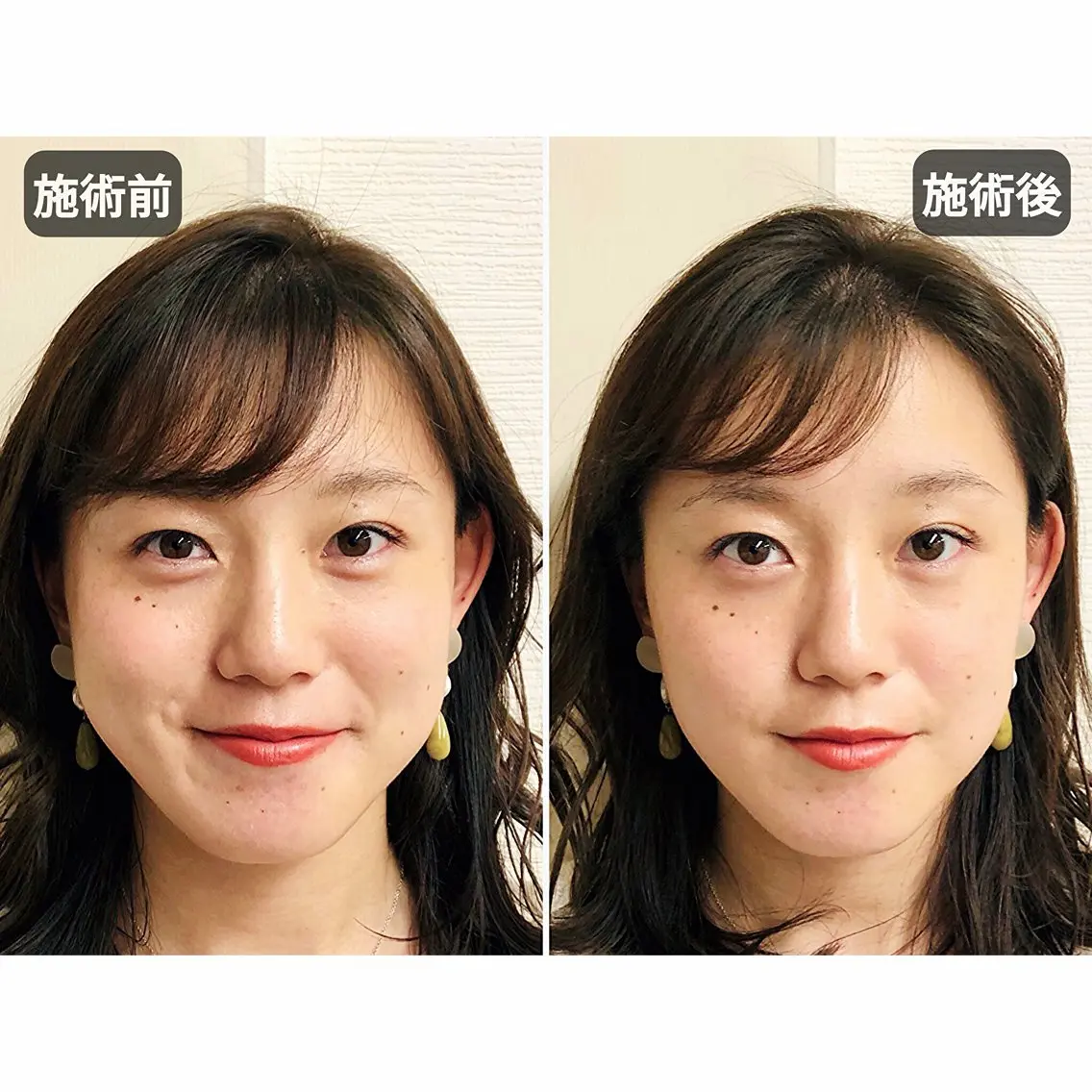 エステ リラク 渋谷 美容鍼 首肩こり YZ先生のエステ・リラクイメージ