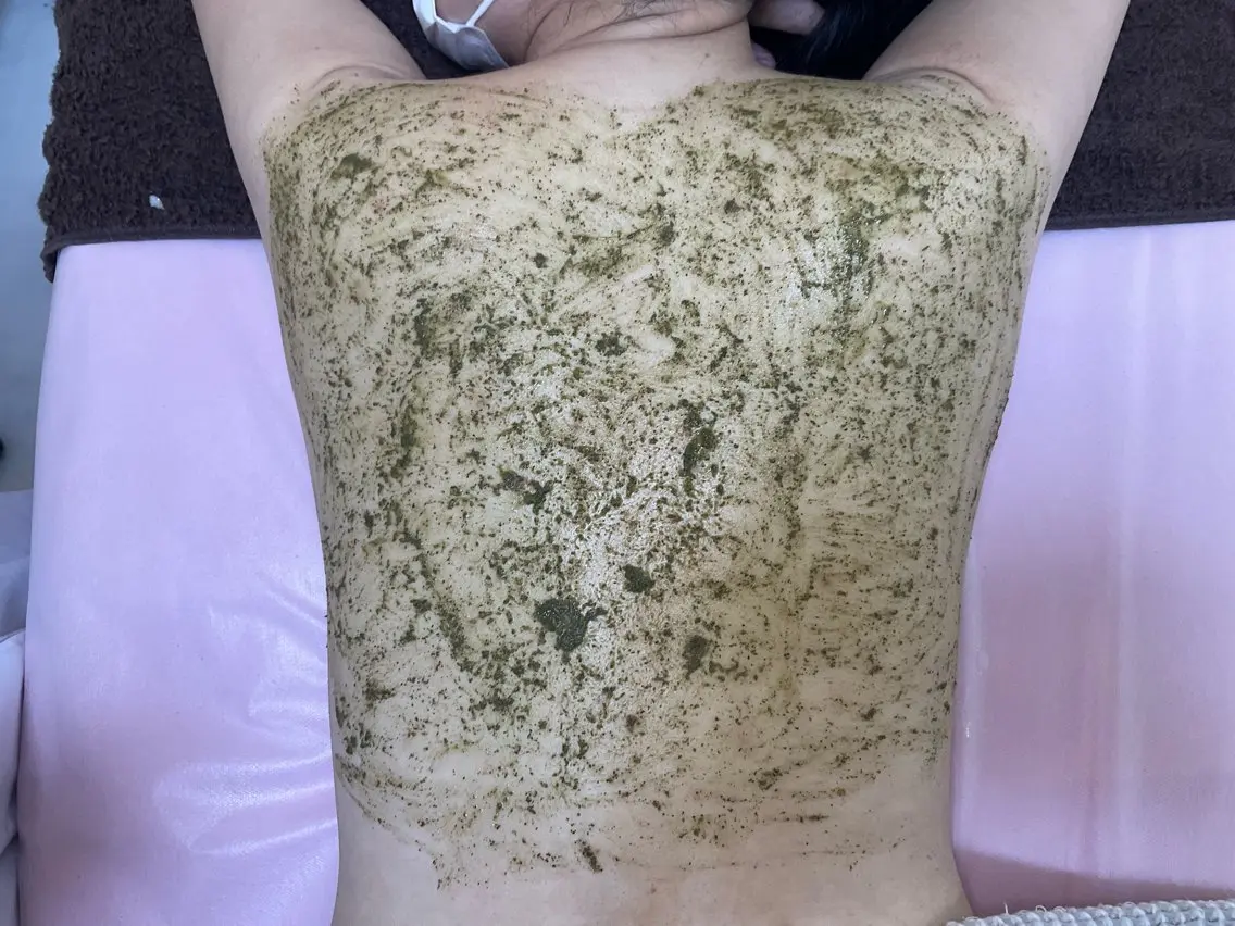 【背中ニキビケア⭐️】剥けないハーブピーリング🌿¥30,800→¥11,000 ❕夏に向けていまから始めましょう♪の写真