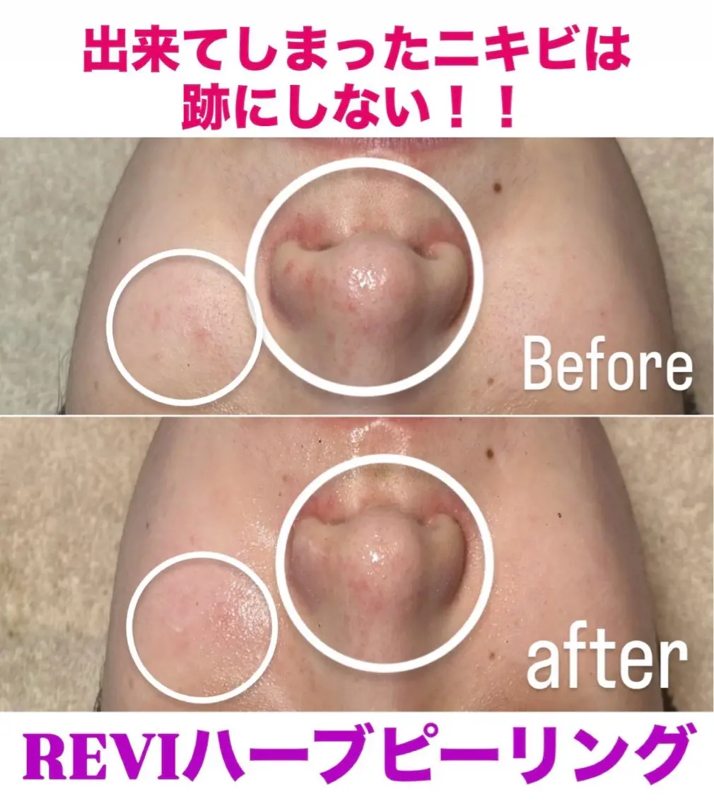 REVIハーブピーリング。ご新規様は¥9900になります。の写真