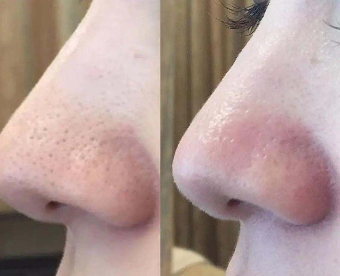 ずっと綺麗にならない鼻の角栓大掃除‼️とにかく鼻だけ即綺麗にするメニュー👃の写真