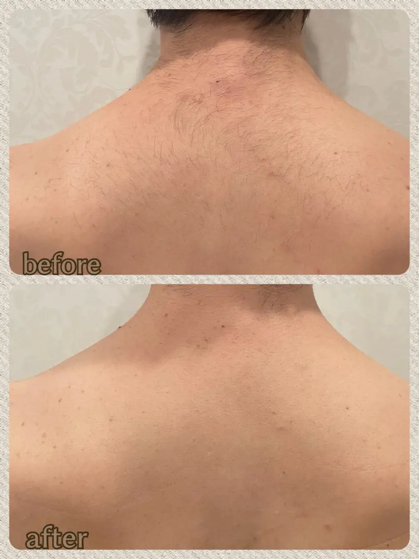 【脱毛】上半身背面パック/¥6600→¥4400の写真