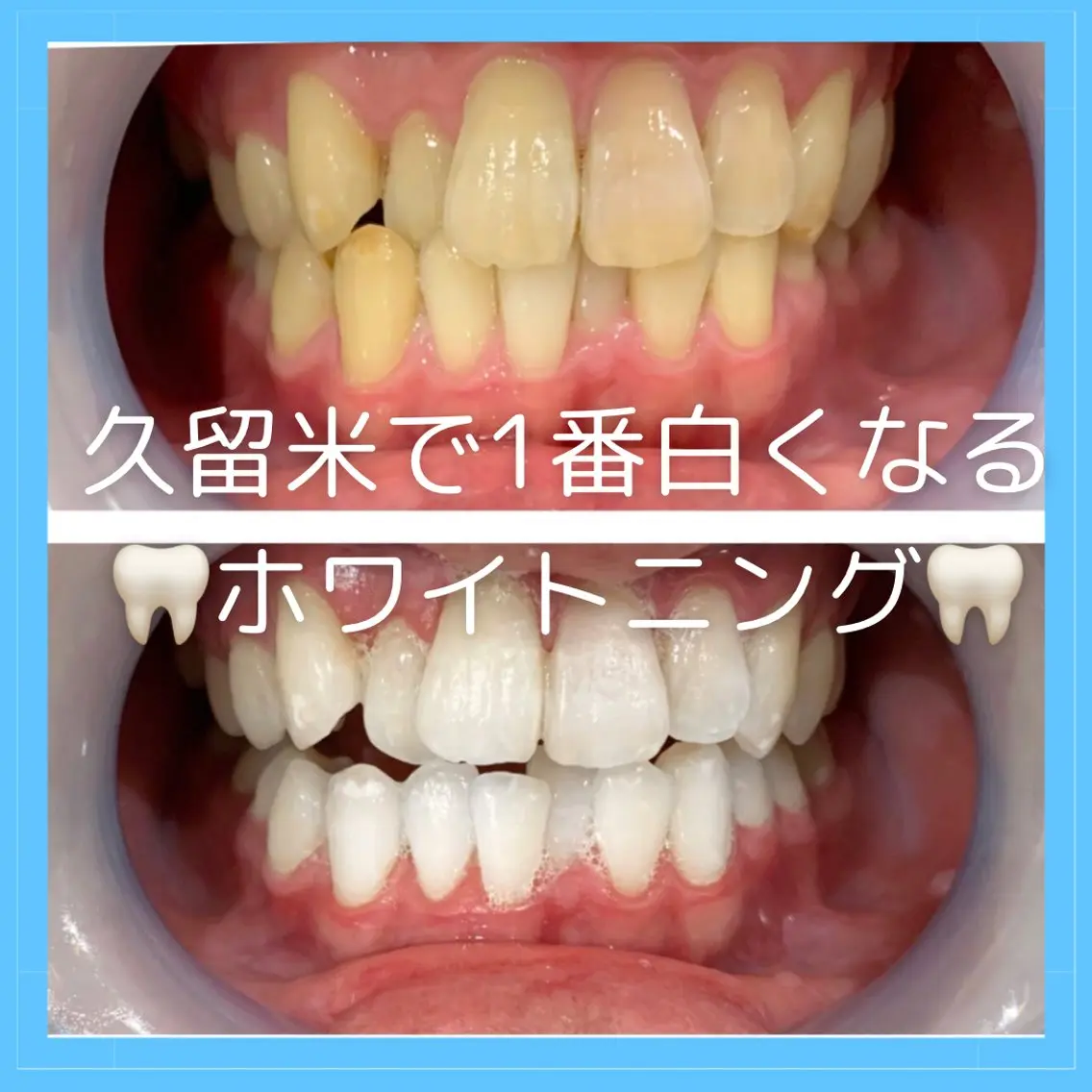 メディカルホワイトニングの写真