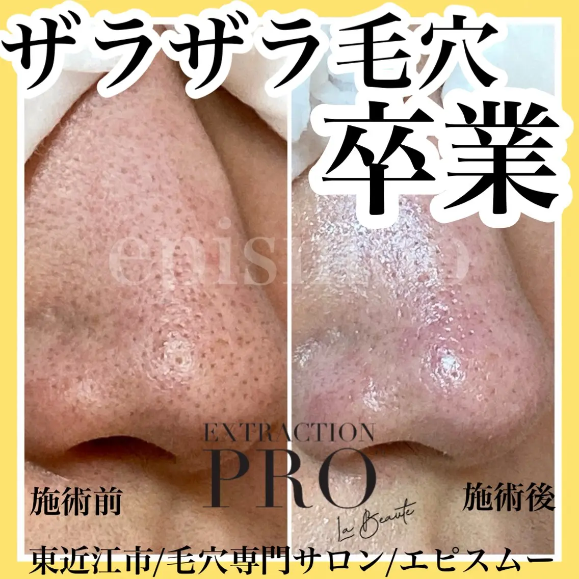 メンズ epismoo 脱毛/HBL/毛穴の眉毛・アイブロウイメージ
