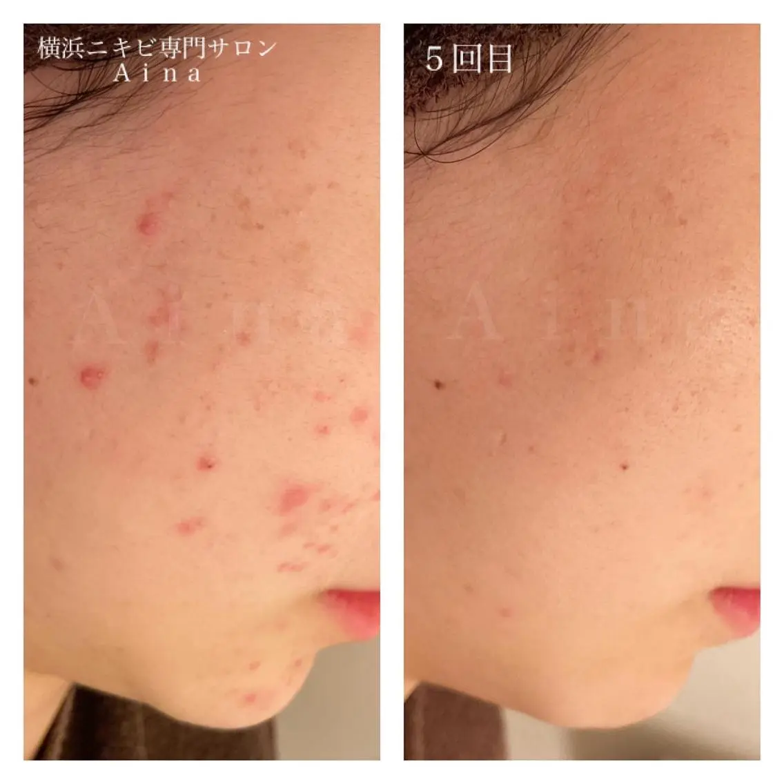 セミロング カラー パーマ ヘアアレンジ メンズ キッズ ネイル マツエク・マツパ 赤色 ニキビ跡専門サロン Ainaのエステ・リラクイメージ