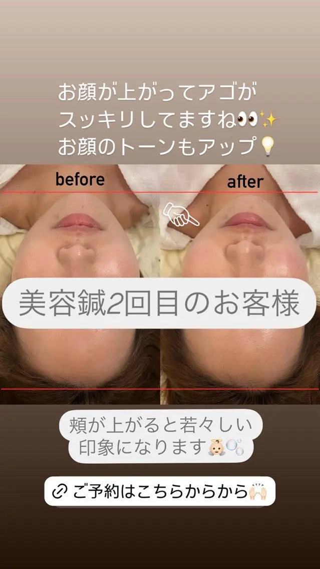 美容鍼/鍼灸 ここみ鍼灸院のエステ・リラクイメージ