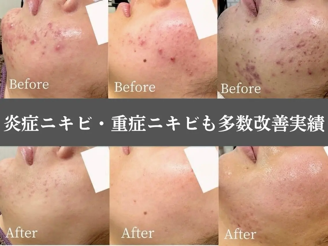 【まずは】一時的でないニキビ根本改善◎ニキビ専門サロン・お肌無料相談の写真