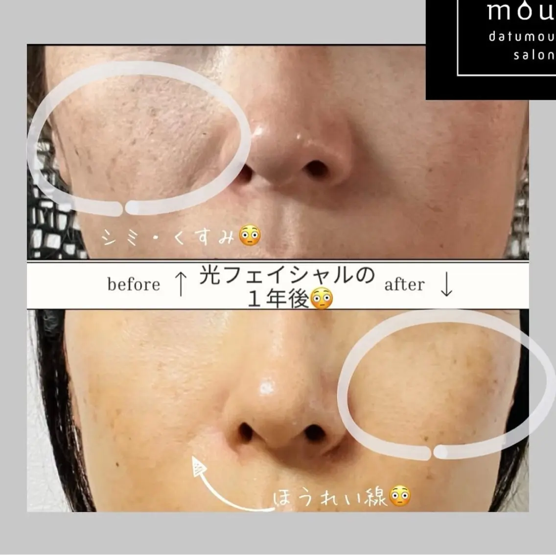 新規限定❗️光フォトエステ💆‍♀️通常8000円→4500円✨内側からの本格的エステをご体感ください‼️の写真
