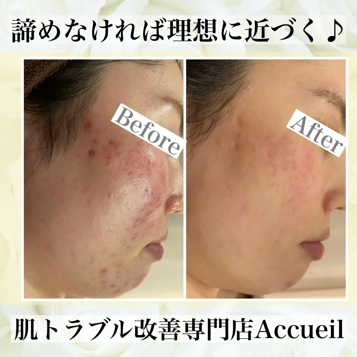 ミディアム カラー パーマ ヘアアレンジ メンズ キッズ ネイル マツエク・マツパ エステ リラク ニキビ・肌質改善専門 ♡人生が変わるサロンのエステ・リラクイメージ