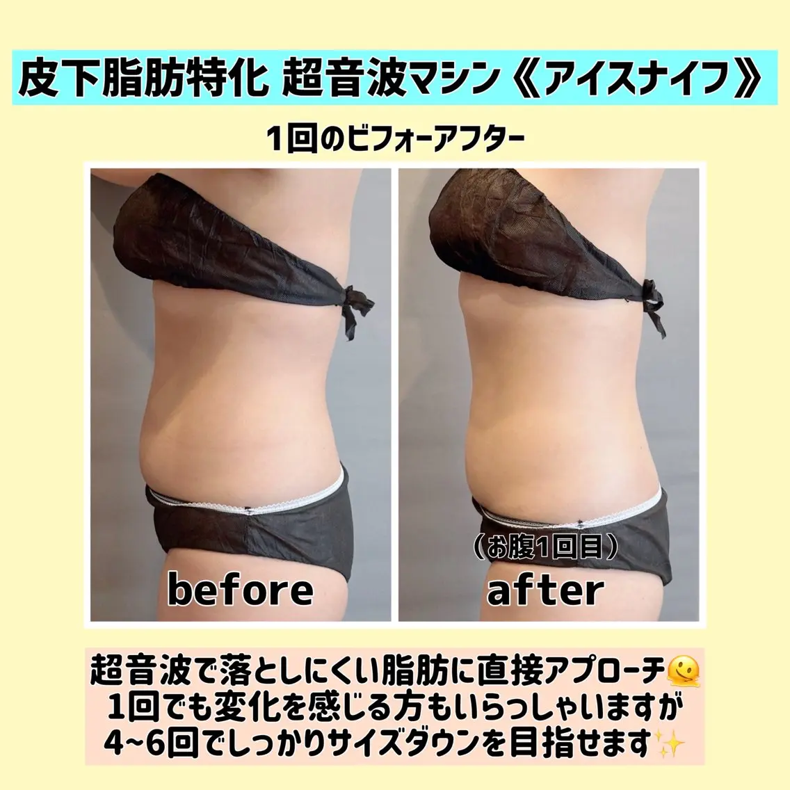 【写真モニター募集】皮下脂肪特化 超音波マシン《アイスナイフ》の写真