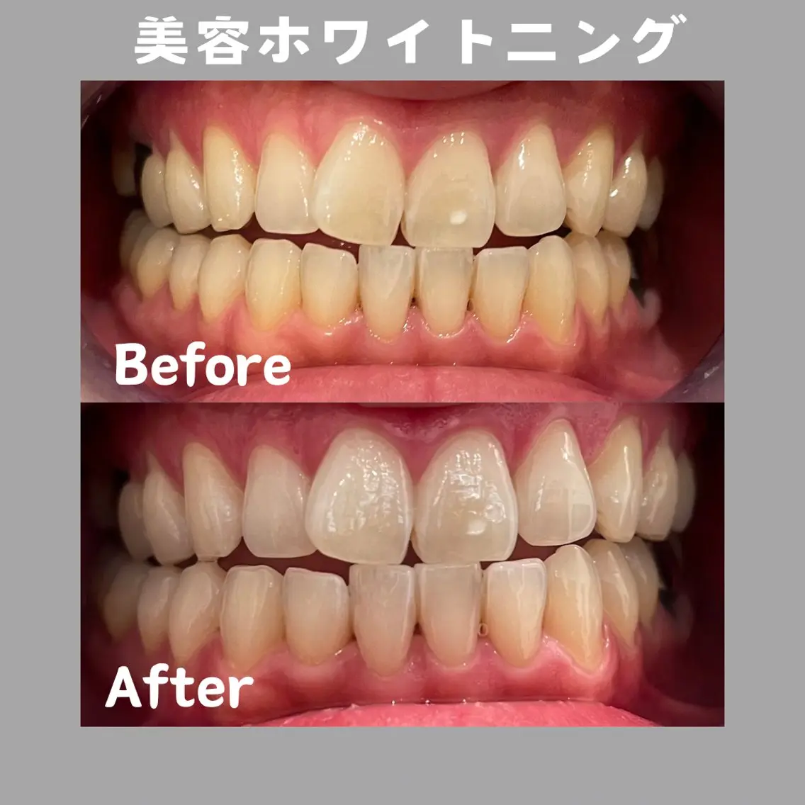その他 Kaula ホワイトニング🦷✨のその他イメージ