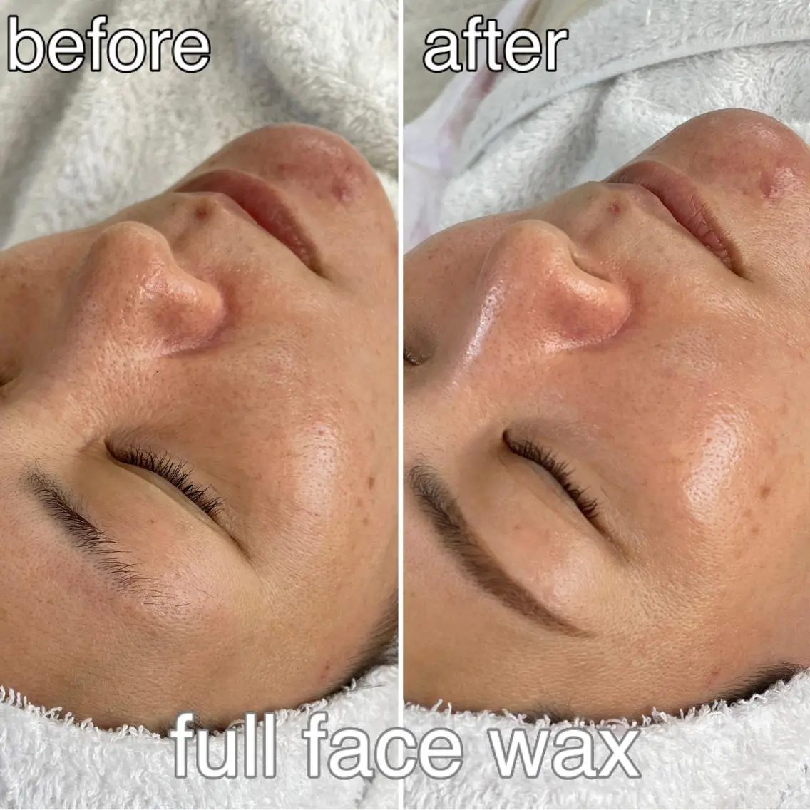 フェイシャルwax(全顔)×眉waxの写真
