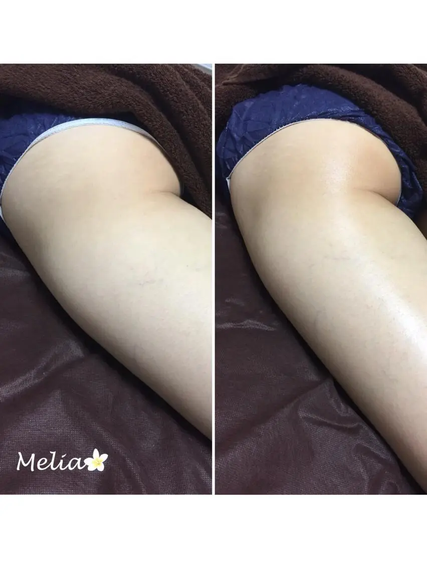 【リンパ痩身】美脚、ウエスト引き締め、ヒップアップ、冷え性の方にオススメ！お試し60分コース 11000円→6600円の写真