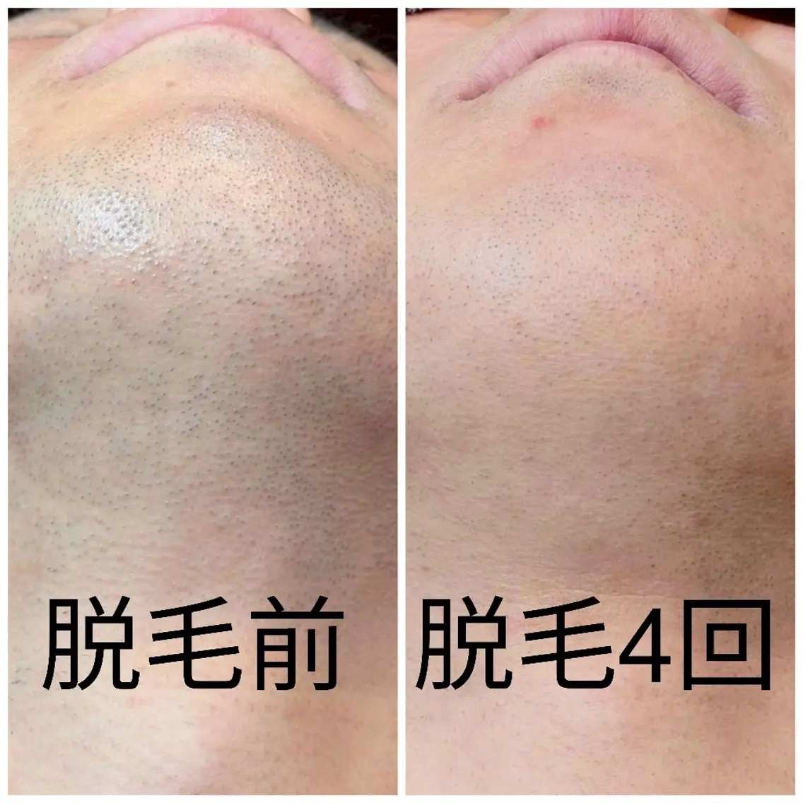 【新規の方】メンズ髭脱毛¥8,000→¥4,000の写真