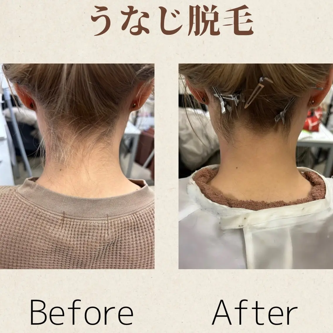 🌹うなじの脱毛🌹の写真