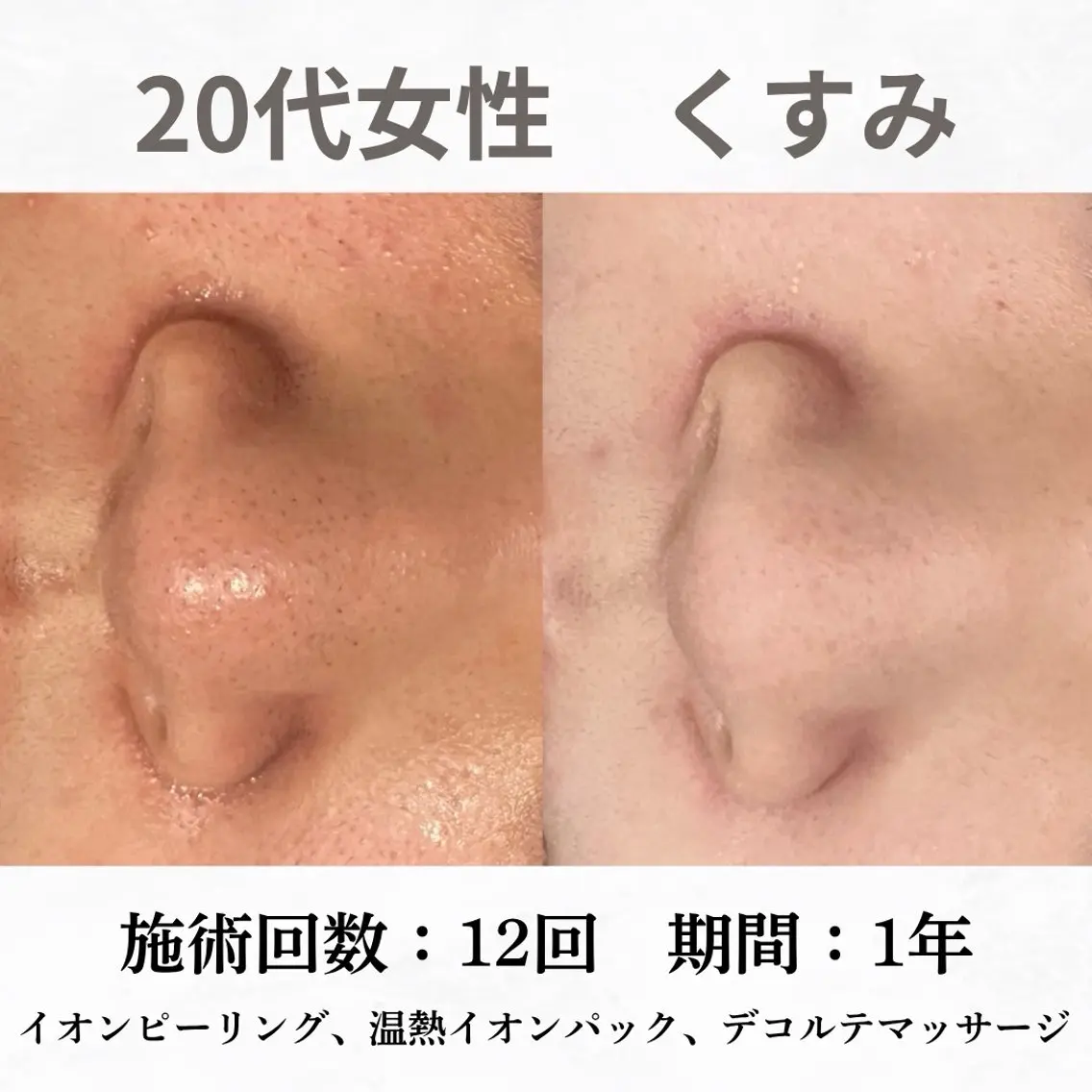 重度ニキビ専門🌼 ダウンタイムなしのエステ・リラクイメージ