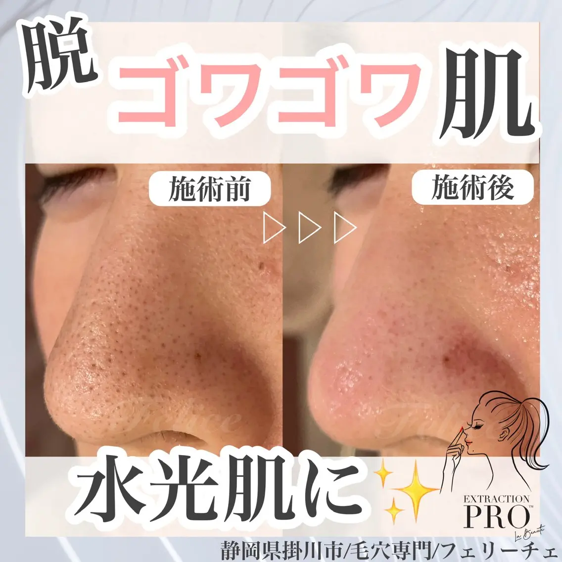 毛穴集中美肌コースの写真