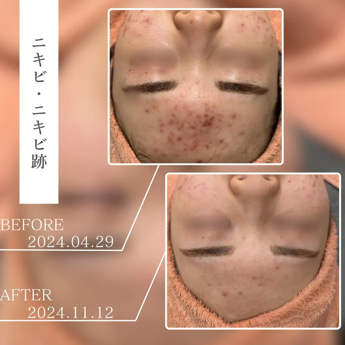 キッズ エステ BestBelleꕤ 大阪福島/肌質改善のエステ・リラクイメージ