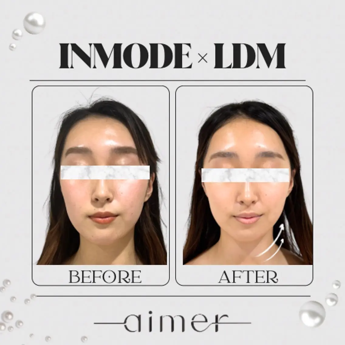 🌿期間限定🌿小顔Vライン生成◆インモード×LDM水玉リフティングの写真