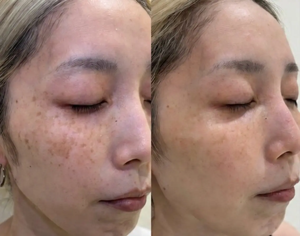 【15分当て放題!プラズマシミケア】ご新規様限定今月の特別価格!¥5,000の写真