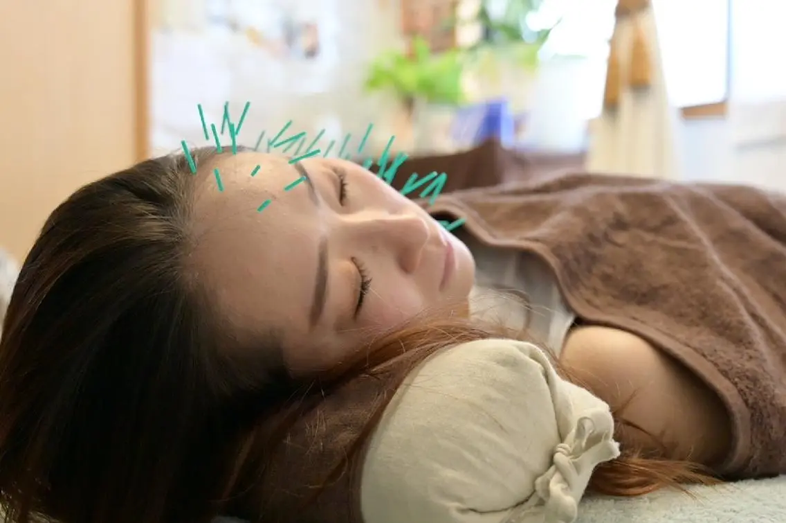5歳若返る美容鍼の写真