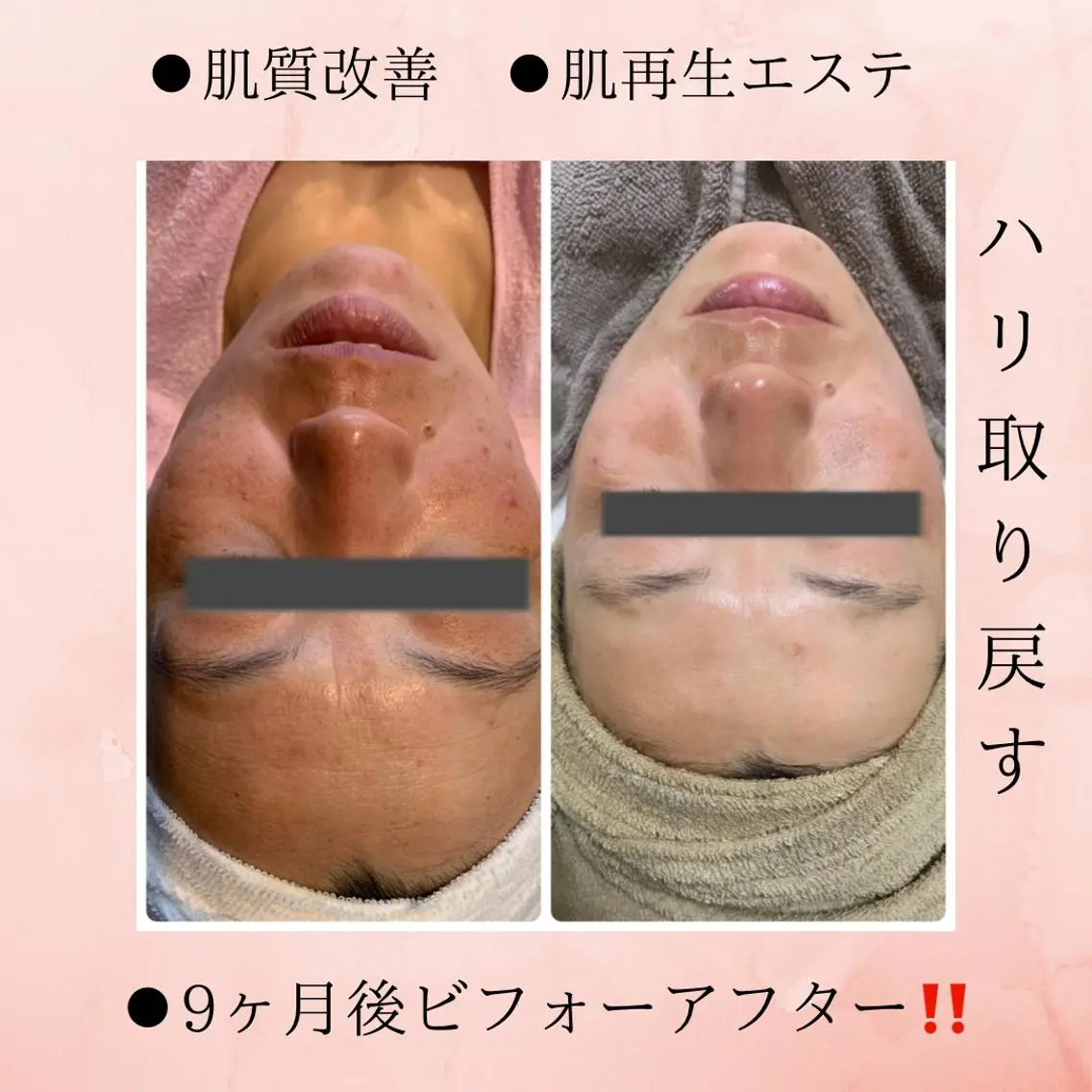 秋冬【ポレーションエステ】今話題のEMSで表情筋をアプローチ‼️シワ・シミ・たるみ・乾燥が気になる方におすすめ✨の写真