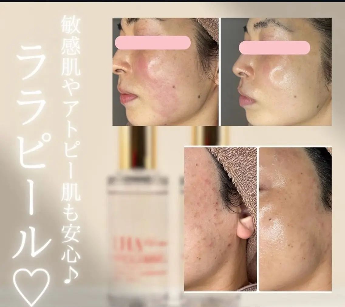 年末まで特別価格‼️ララピール✖️毛穴洗浄！お肌にツヤ、ハリ出したい方‼️みずみずしい肌にしたいなら💛の写真