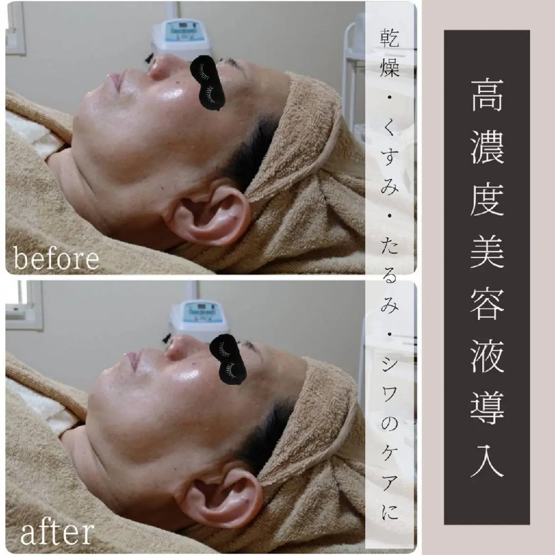 【高濃度美容液導入+小顔EMS】潤いハリツヤ肌への写真