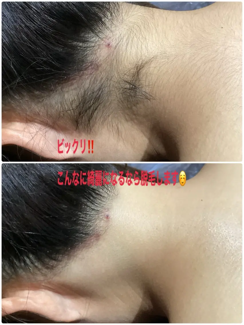 【全身＋VIO脱毛】1番人気🥇2900人が利用！全箇所自己処理不要💁🏻‍♀️剃らずに来店ok👌1回¥9000の写真