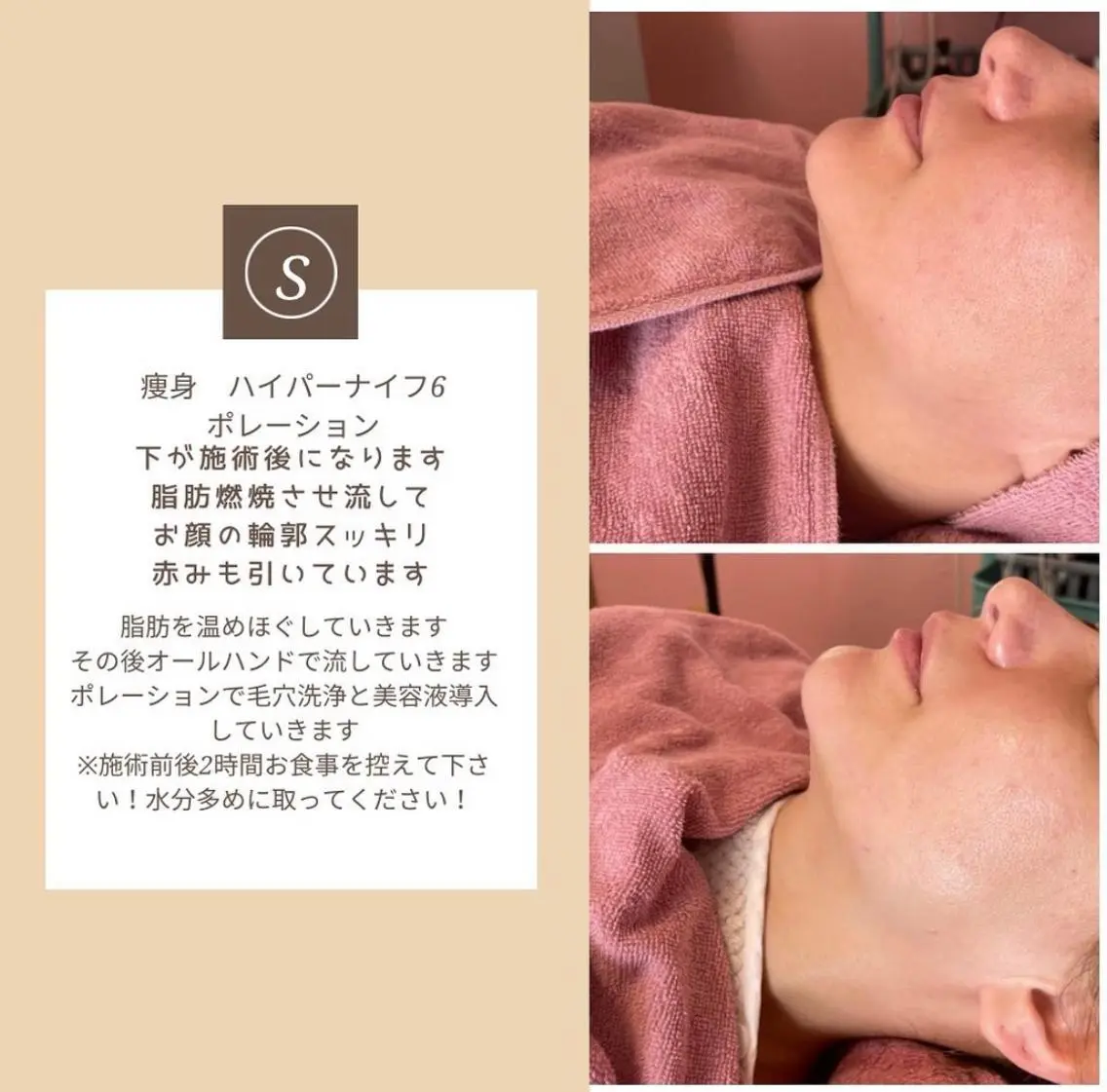 小顔ハイパーナイフ＋リンパマッサージの写真