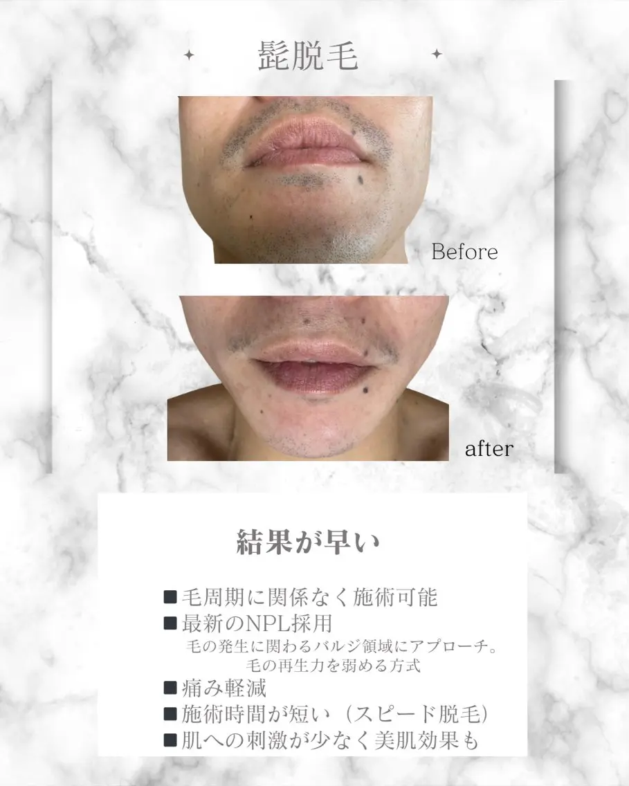 メンズ 脱毛 岡口 公子のエステ・リラクイメージ