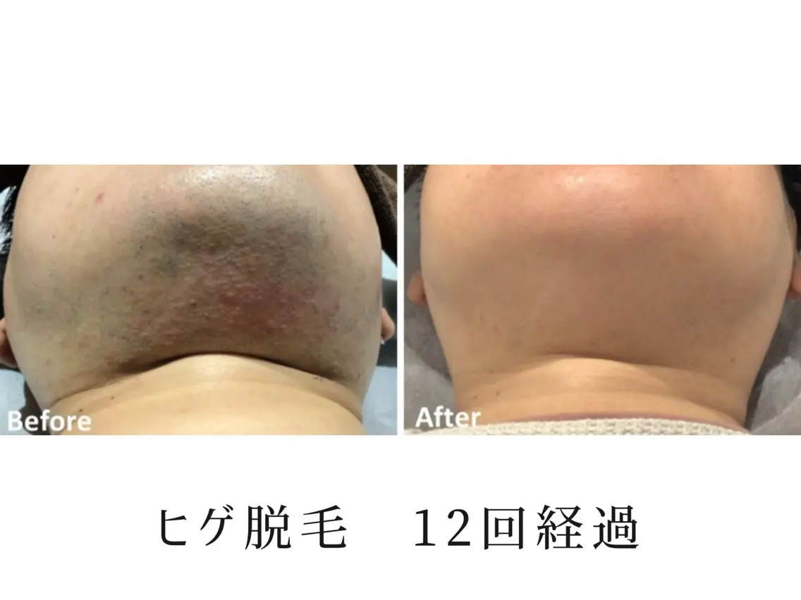 脱毛 Hair Peace 脱毛サロンのエステ・リラクイメージ