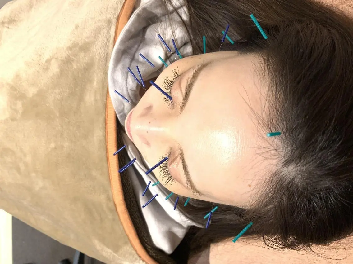 ✨美容鍼（学生限定）学割✨の写真