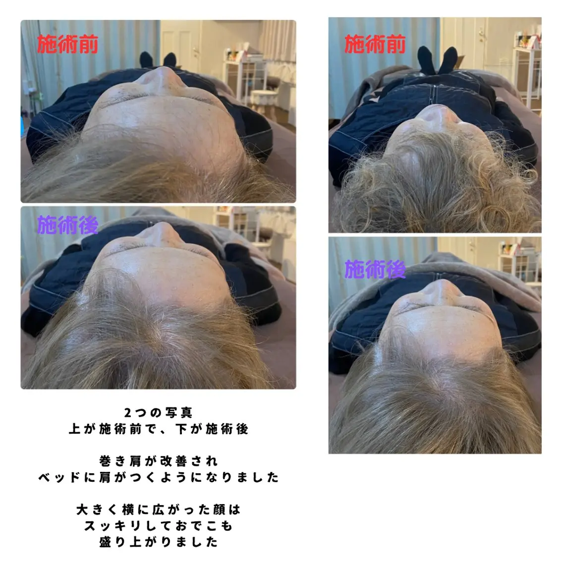 【大人気NO.1】筋膜アプローチ+ドライヘッドスパ60分 110分の写真