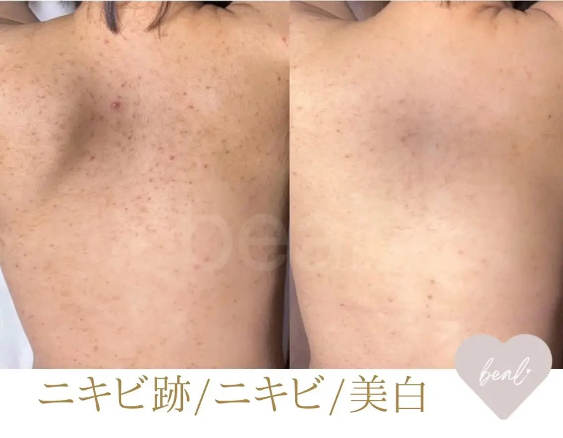 残り2名背中ニキビケア/跡】上半分/最高級★剥離有ハーブピーリング¥60000→の写真