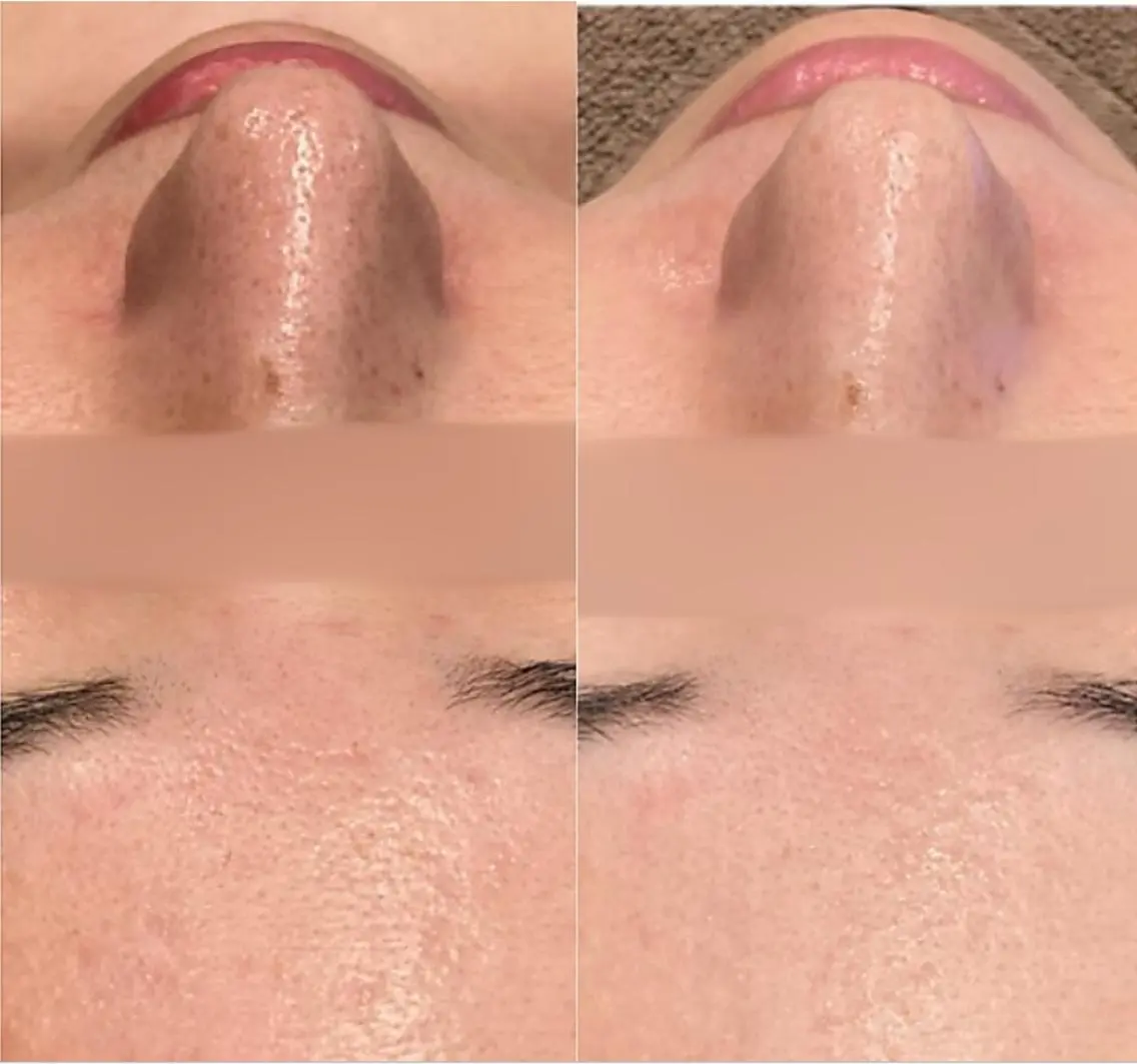 NEW🌟育てて守る《肌育コラーゲン導入》付毛穴洗浄ハイドロfacial🫧の写真