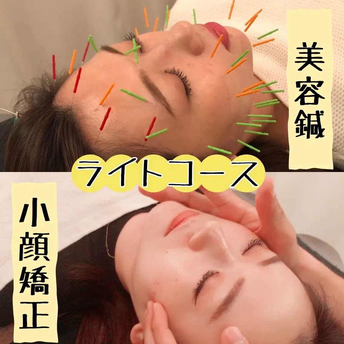 【40本使用】美容鍼＋小顔矯正🌟ライトコースの写真