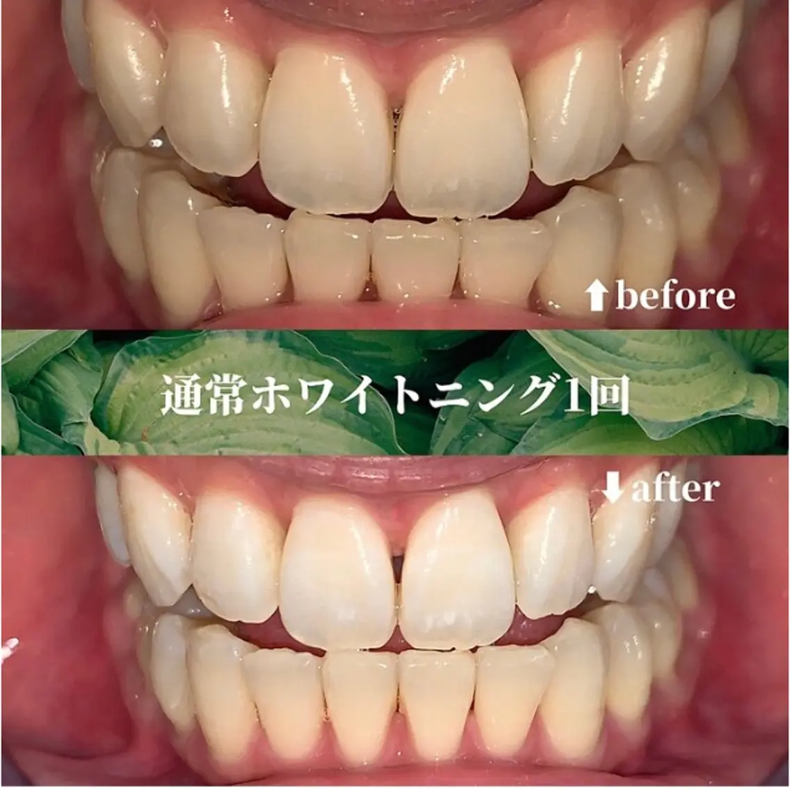 【人気No.1コスパ最強◎自然な白さへ】セルフホワイトニング30分照射　初回体験の写真